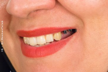 ایمپلنت بیماران دیابتی