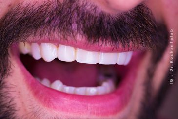 بلیچینگ دندان