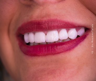 لمینیت سرامیکی