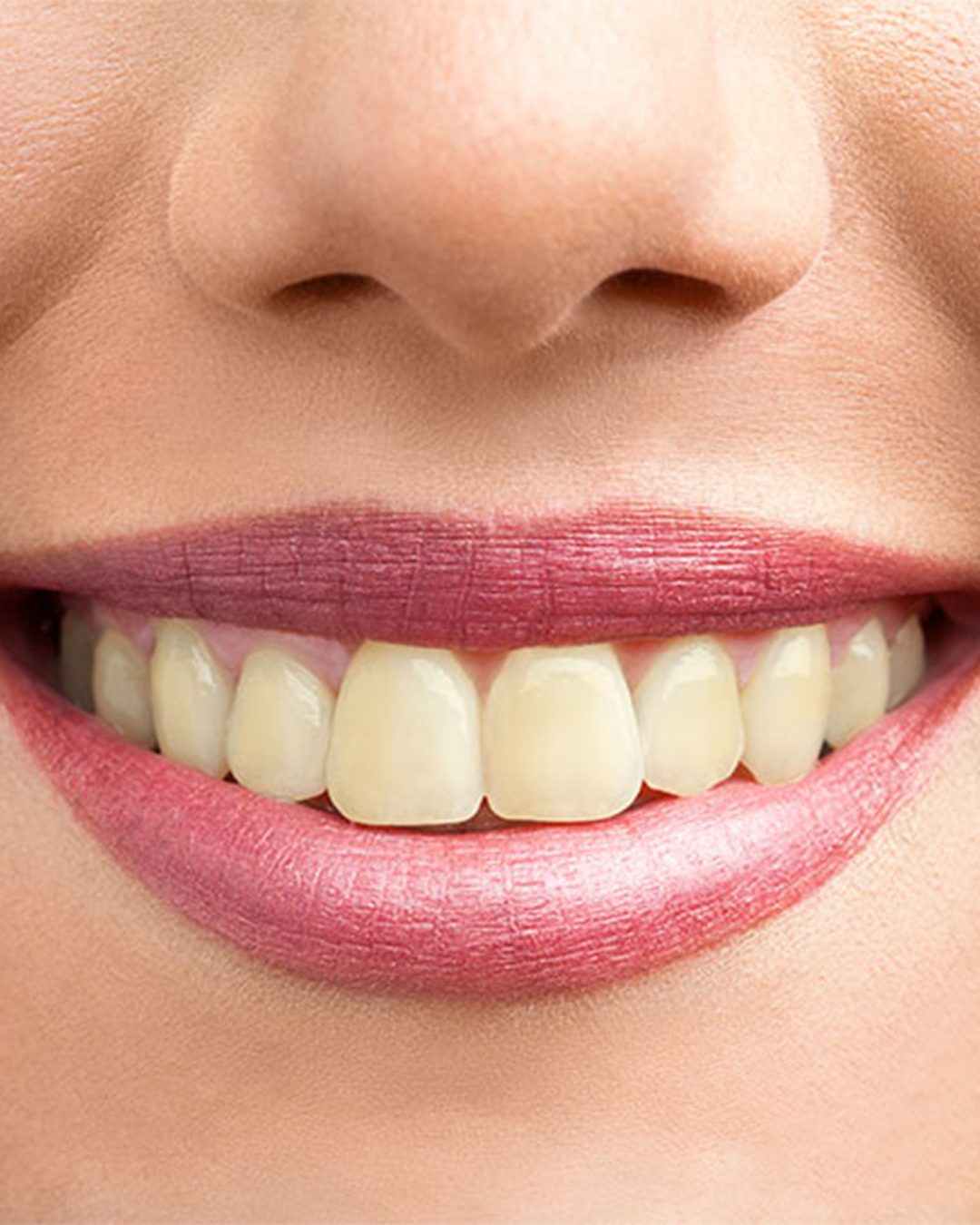 پکیج سفید کردن دندان - Image 3