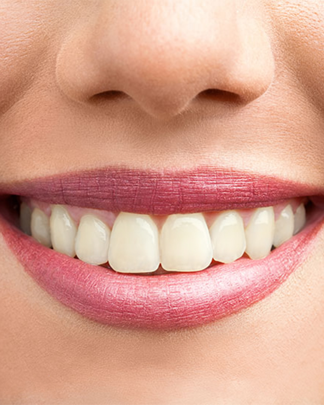 پکیج سفید کردن دندان - Image 4