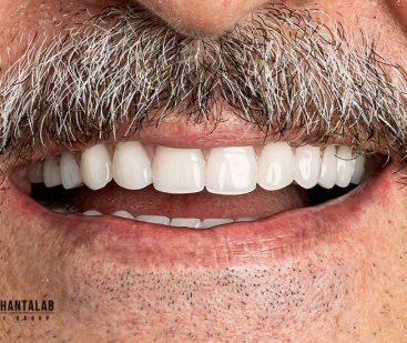 کاشت ایمپلنت تخصصی در رشت