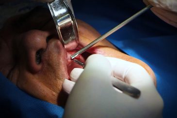 اوردنچر متکی بر ایمپلنت