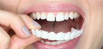 snap on smile