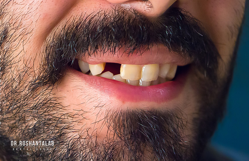 ایمپلنت برای بیماران دیابتی
