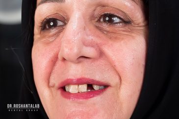 کاشت ایمپلنت بدون درد