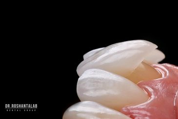 لمینیت سرامیکی ایمکس