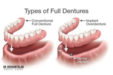تفاوت اوردنچر با دندان مصنوعی