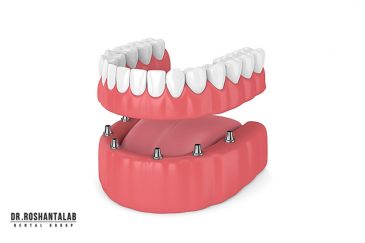 تفاوت اوردنچر با پروتز ثابت