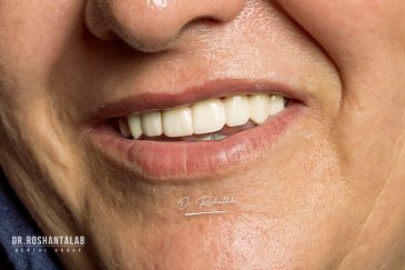 ایمپلنت فول موس سرامیکی