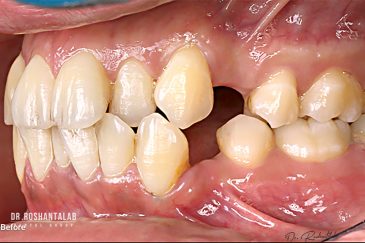 ارتودنسی بهتر است یا لمینت دندان؟