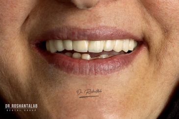 ایمپلنت کامل فک بالا