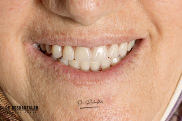 دندان مصنوعی