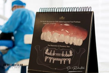 ایمپلنت بدون درد