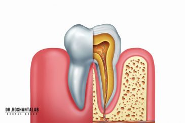 عصب کشی دندان