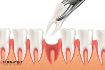 کشیدن دندان یا درمان ریشه