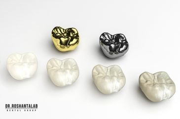 روکش و انواع آن