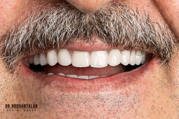 ایمپلنت دیجیتال در رشت