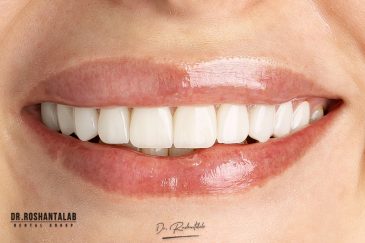 لمینیت سرامیکی