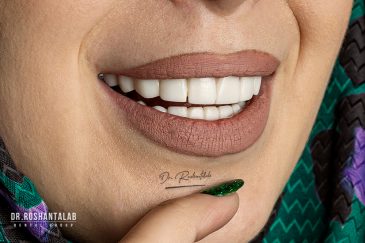 خمیر دندان مناسب کامپوزیت ونیر