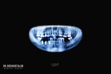 جرم گیری ایمپلنت ها