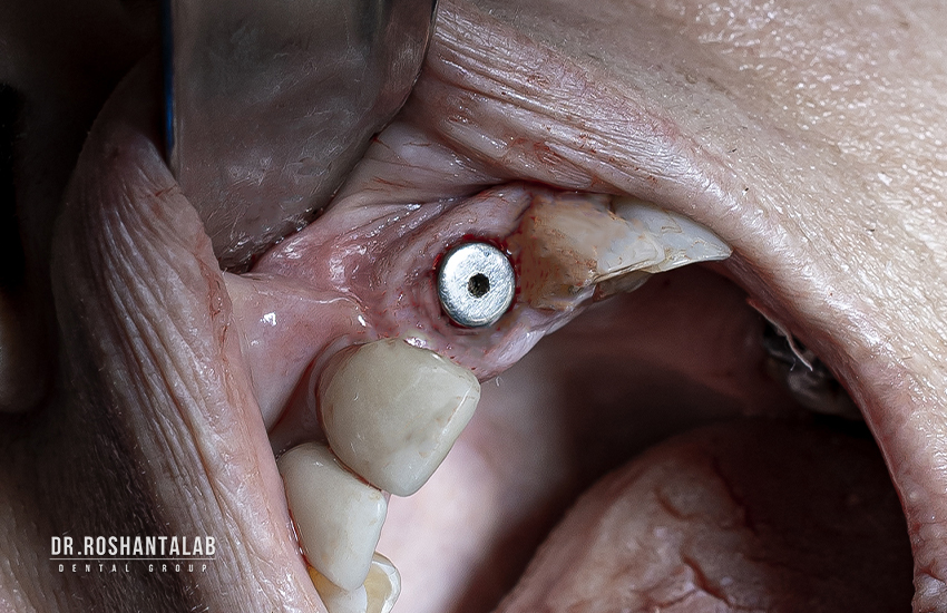 ایمپلنت بدون درد و جراحی : ایمپلنت پانچ دکتر روشن طلب