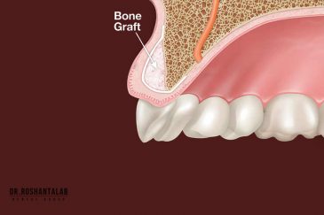 پیوند استخوان