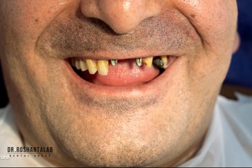 روش های جایگزینی دندان از دست رفته