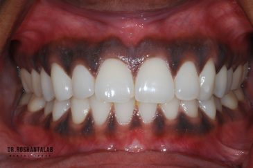 علت تیرگی لثه