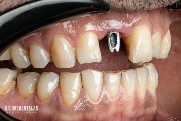 مراقبت های بعد از تحویل پروتز