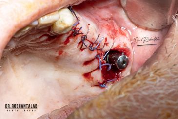 مراقبت های بعد از ایمپلنت دندان