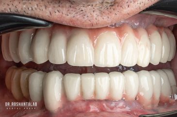 ایمپلنت دندان چند جلسه طول می کشد؟