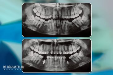 اول ارتودنسی یا ایمپلنت؟