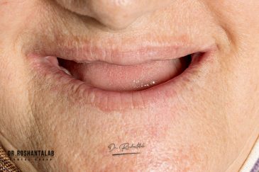 جایگزین دندان مصنوعی با ایمپلنت