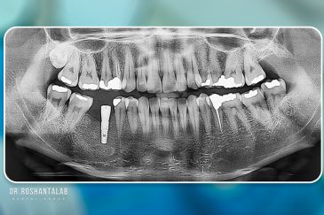 ایمپلنت برای افراد سیگاری