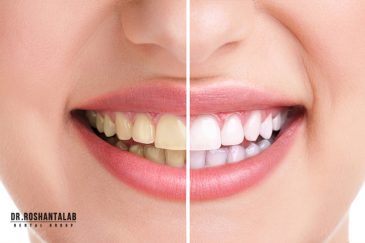 تفاوت بلیچینگ با جرم گیری