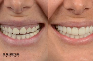 جراحی زیبایی لثه | مراحل و روش ها