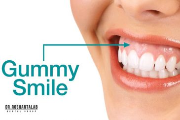 لبخند لثه ای