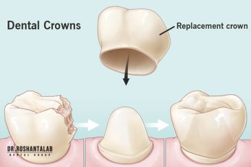 روکش دندان بعد از عصب کشی