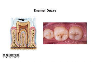 پوسیدگی دندان و درمان آن