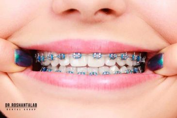 دلیل زرد شدن دندان حین ارتودنسی