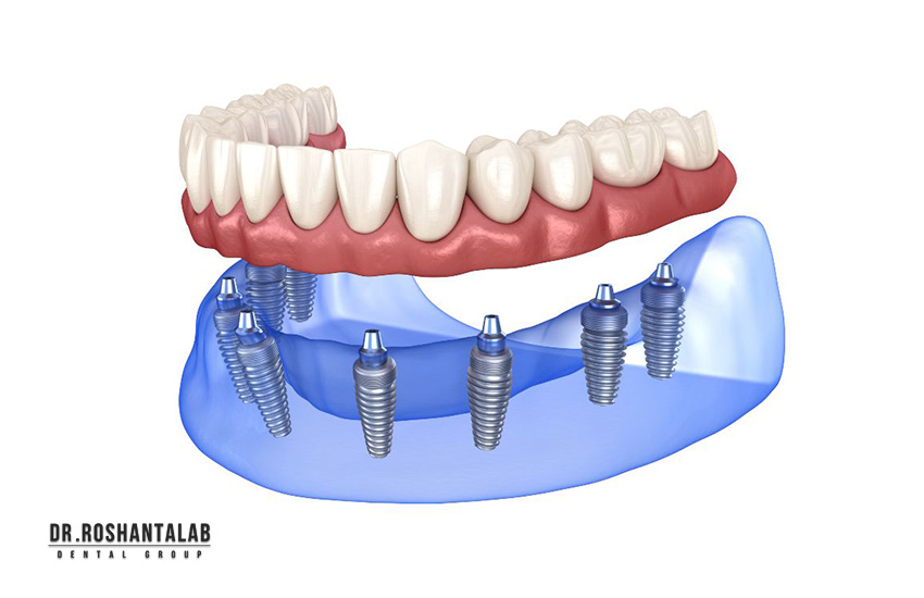 کاشت ایمپلنت دیجیتال در گیلان