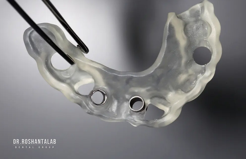 سرجیکال گاید: ایمپلنت دیجیتال در رشت