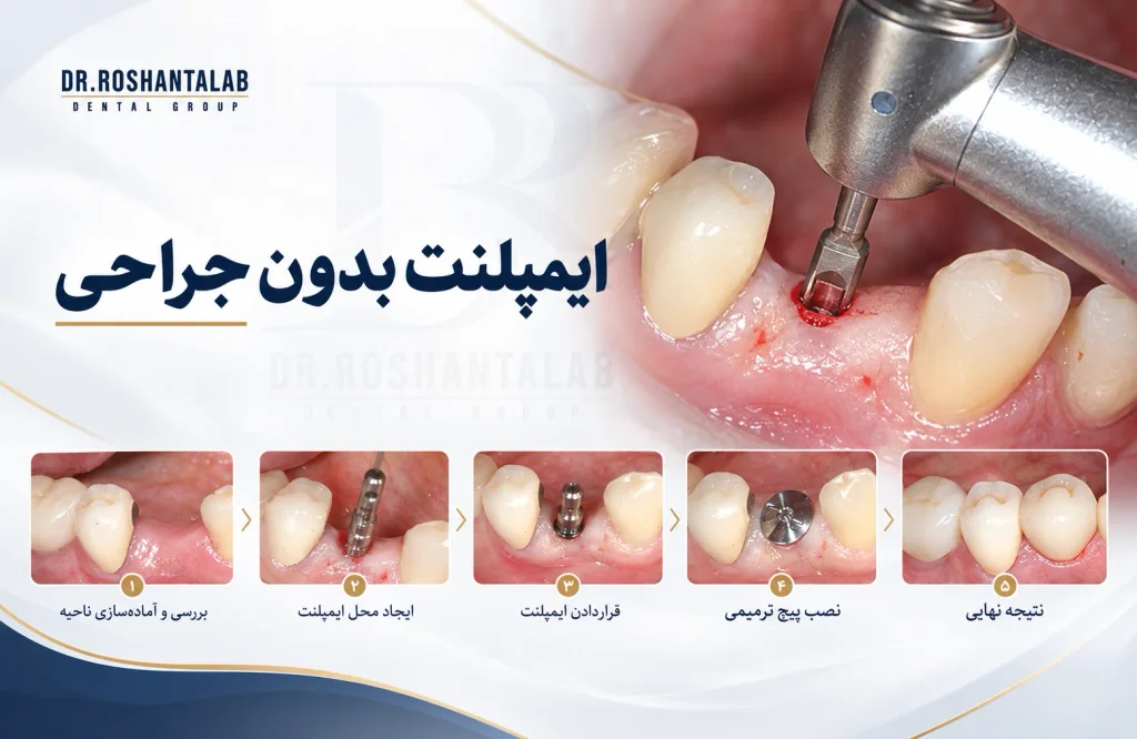 ایمپلنت بدون جراحی در رشت
آیا ایمپلنت پانچ همان ایمپلنت فوری است؟