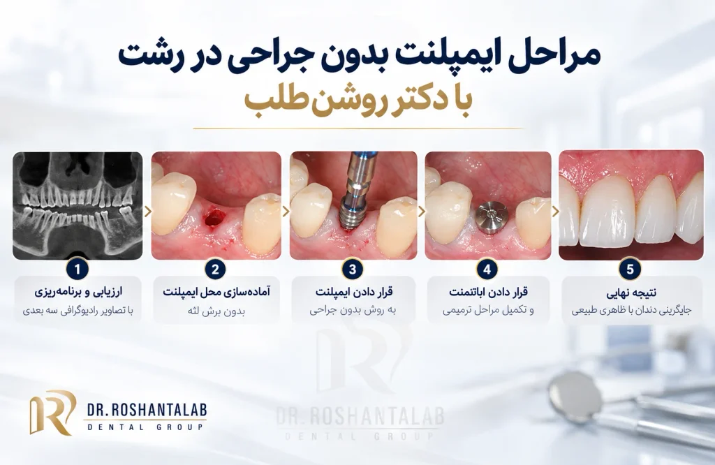 مراحل ایمپلنت بدون جراحی در رشت با دکتر روشن‌طلب