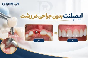 ایمپلنت بدون جراحی در رشت