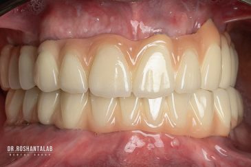 مراحل ایمپلنت دیجیتال: 4 مرحله‌ تا لبخندی ماندگار