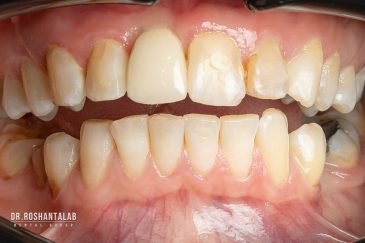 ایمپلنت دندان در رشت: 5 راز لبخندی دائمی با متخصصان برتر