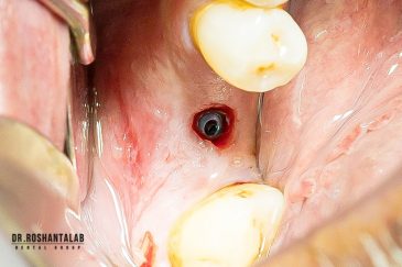 ایمپلنت بدون جراحی