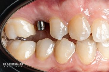 ایمپلنت در گیلان